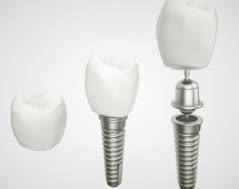 五、二氧化锆全瓷牙的适用场景与维护要点