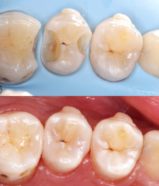 二、根管治疗与烤瓷牙的核心区别