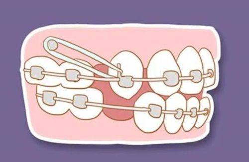 四、拔牙后8小时至1周：逐步过渡，兼顾营养促愈合