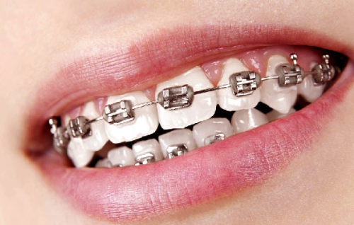 二、单颗/前牙修复：选对牙冠兼顾美观与耐用