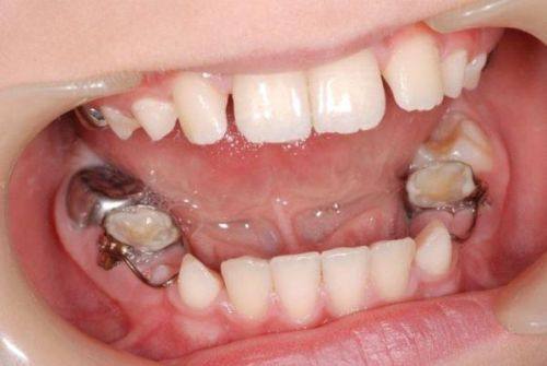 六、地包天矫正后的注意事项