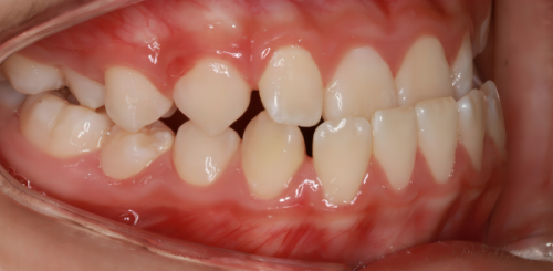 三、后牙大咬合力区域：耐用性优先的牙冠选型