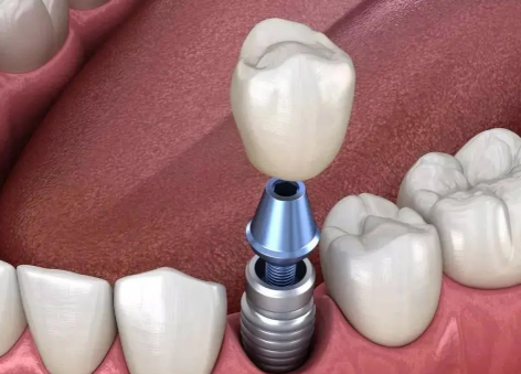 三、钛合金烤瓷牙与纯钛烤瓷牙的差异