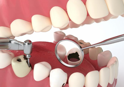 四、从功能本质看窝沟封闭和补牙的材料差异