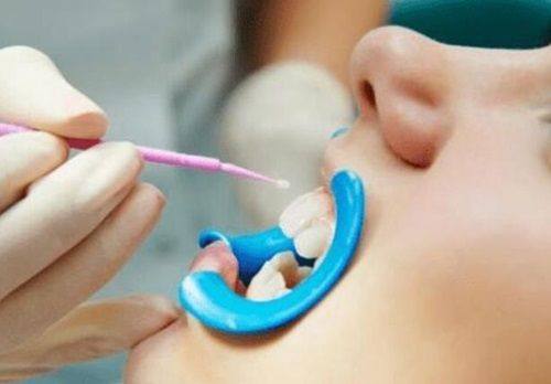 四、二氧化锆全瓷牙安装后的日常维护细节