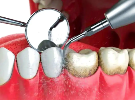 三、龋坏进展至深层：蛀牙“侵入”牙神经必须根管干预