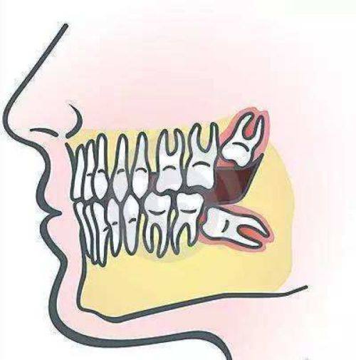 三、分洞型：大小龋洞选材不盲目