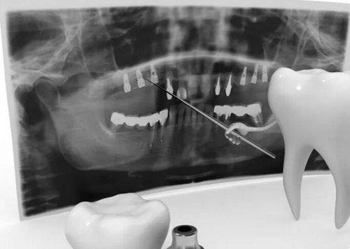 三、钛合金、纯钛烤瓷牙：做CT无任何影响，核磁也能放心做