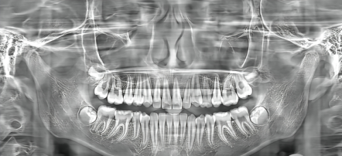 五、全瓷牙全口修复的注意事项