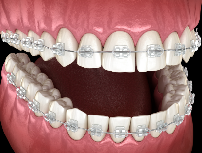 四、地包天下巴长矫正的费用参考