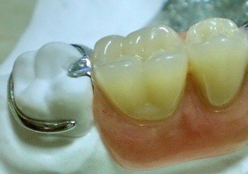 二、不同种植牙型的戴冠核心差异对比