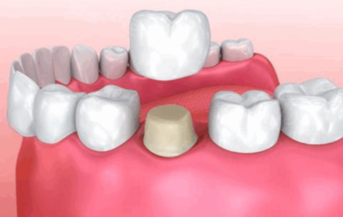二、分阶段适配的精细种植时机：根据口腔条件灵活选择