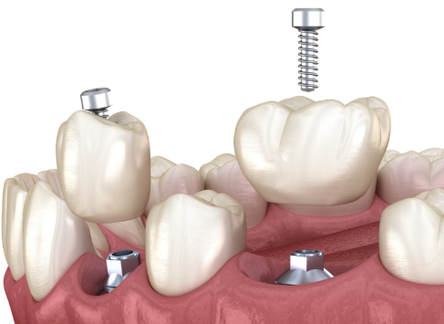 四、如何预防补牙材料再次变色