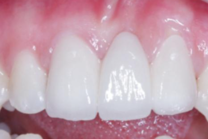 四、预防补牙材料脱落的实用策略