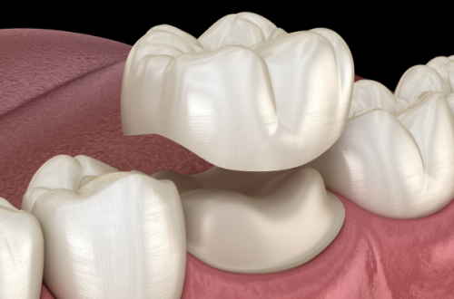 三、这些牙疼情况，无需做根管治疗