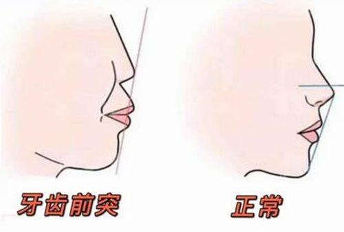 三、15岁整牙地包天晚吗？时机选对能缩短矫正周期