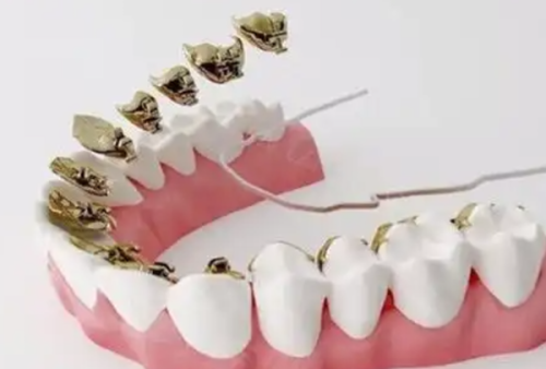 五、选择威兰德全瓷牙的额外注意事项，减少后续风险