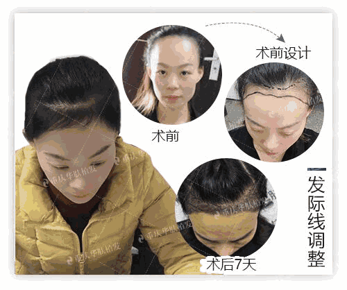 重庆华肤皮肤病医院植发科预约挂号方式：