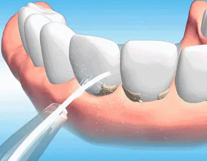 二、这些牙疼情况，必须做根管治疗