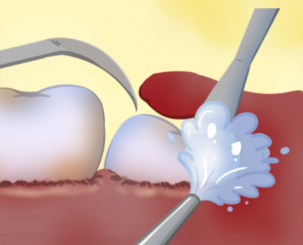 三、这些情况强烈建议做牙冠