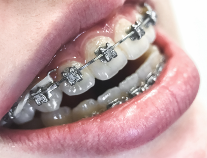 三、根管治疗操作全流程：从评估到治疗的步步为营