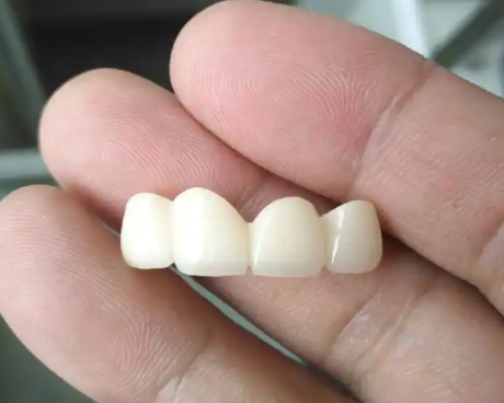 五、牙齿有结石需要洗牙吗？洗牙的注意事项与选择建议