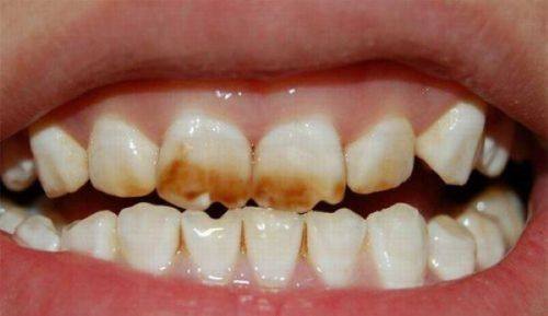 种植牙和烤瓷牙的比较哪个好？分情况选更合适 知乎热门问题全解析