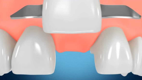 五、预算有限？这些材料能满足基础补牙需求