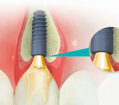 四、好的全瓷牙和便宜的全瓷牙有什么区别？