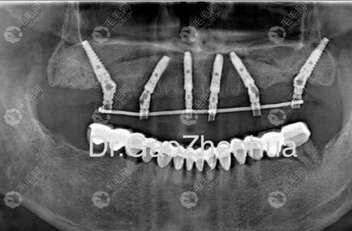 西吉县雅康口腔门诊部价格表：