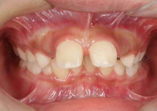 四、烤瓷牙旁边的牙齿坏了怎么补？分情况选择修复方式