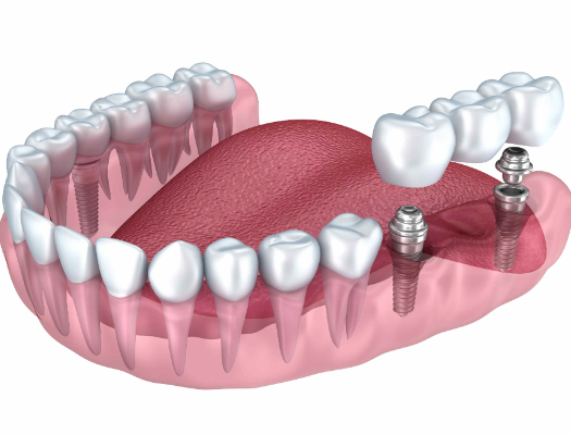 三、决定根管治疗后牙齿使用寿命的核心因素