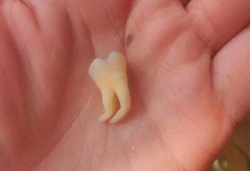 五、关于根管牙寿命的常见误区澄清