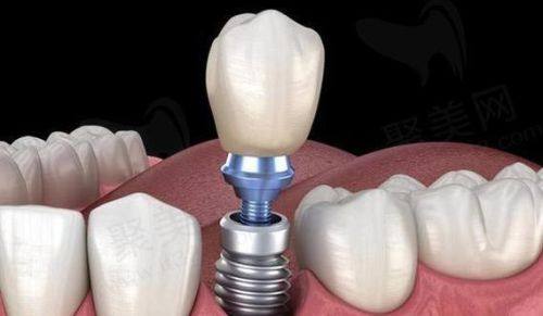 厦门登特口腔医院(莲花分店)价格表：