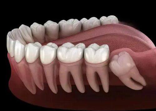 三、根管治疗术后多长时间不疼才正常