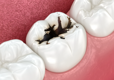 五、拉瓦全瓷牙门牙修复的预算参考