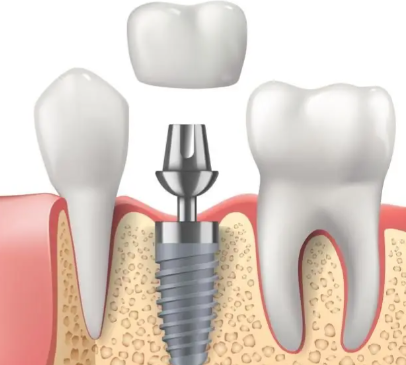五、韩国登腾种植牙和奥齿泰哪个好？同档品牌各有侧重