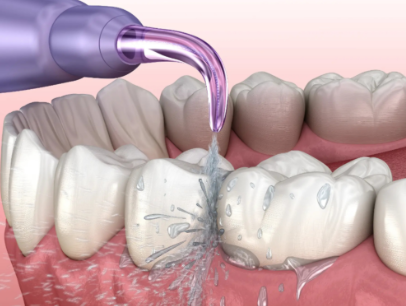 四、儿童拔牙矫正的危害有哪些症状？早发现早干预