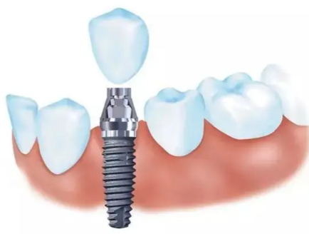 二、儿童拔牙矫正会不会留下后遗症？风险多为短期可控