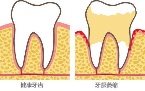 四、二氧化锆全瓷牙硬度比真牙差多少？