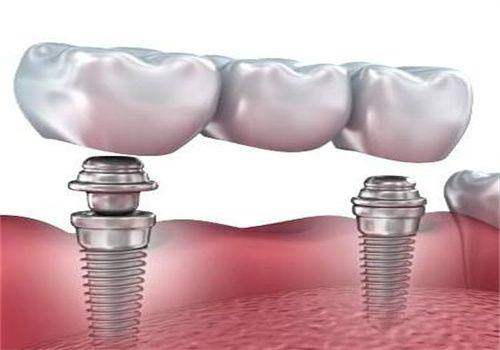 开封植得口腔医院价格表: