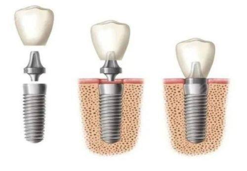 五、三十岁地包天矫正的注意事项