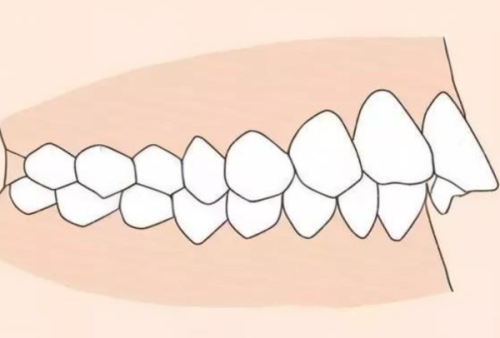三、龋坏引发根尖周炎时需要根管治疗