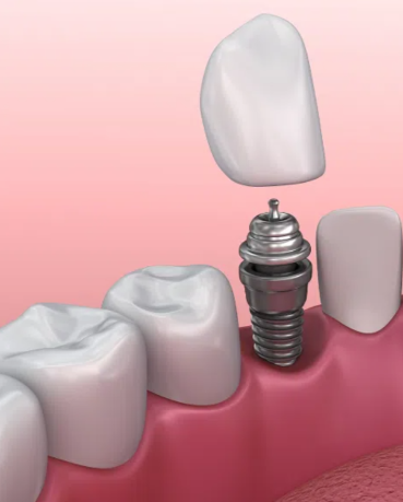 二、全瓷牙冠的制作流程拆解