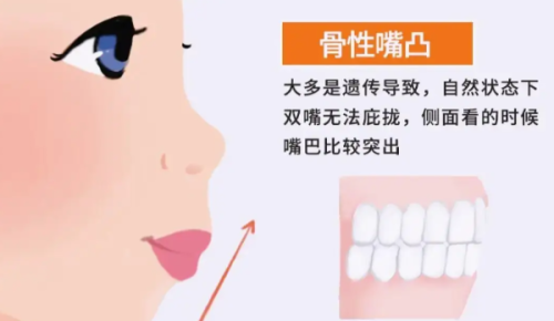 二、成人根管治疗的常见副作用与风险