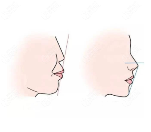 五、哪些情况需要做根管治疗，哪些需要杀神经