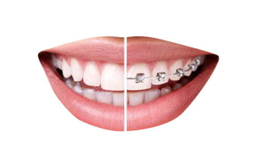 五、四环素牙专属美白方案