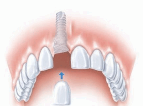 三、13岁女孩地包天矫正的术前检查要求