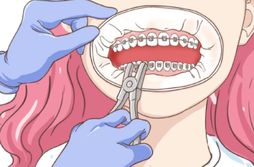 三、拔牙术后饮食与口腔清洁要点