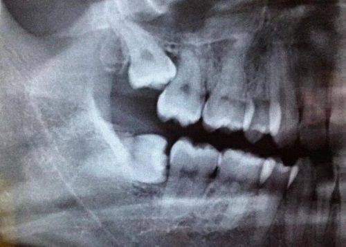四、主流的地包天矫正方式